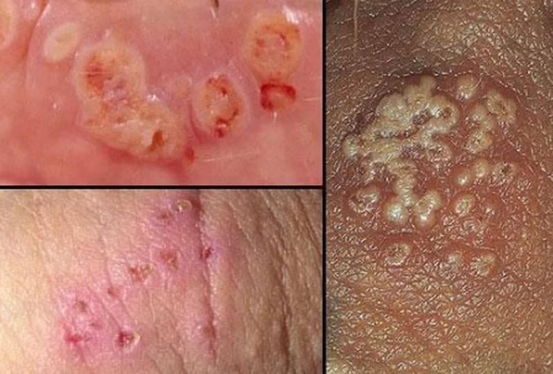 Bệnh lậu có nguy hiểm không? Một số triệu chứng thường gặp 1