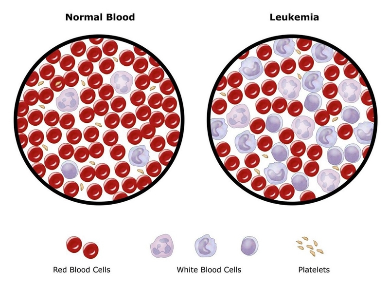 Bệnh leukemia là gì? Cách chẩn đoán và điều trị bệnh leukemia thế nào? 1