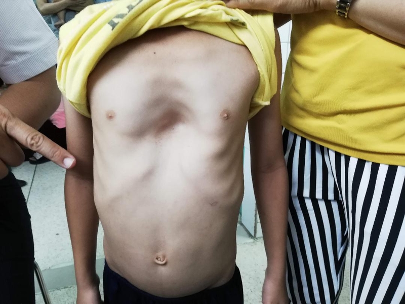 Bệnh lõm ngực: Nguyên nhân, biến chứng và điều trị 1