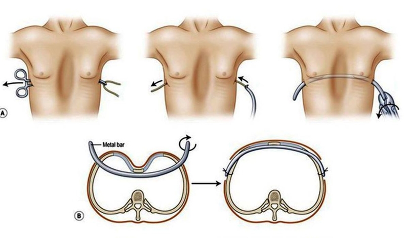 Bệnh lõm ngực: Nguyên nhân, biến chứng và điều trị 3