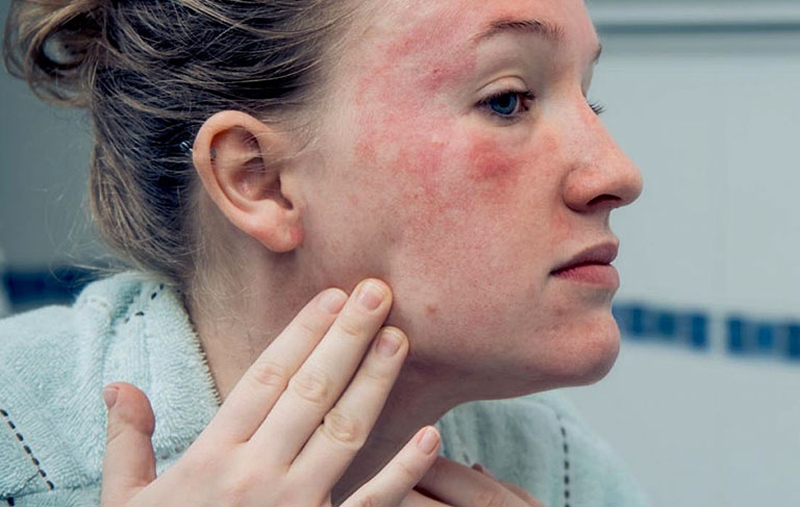 Lupus ban đỏ rụng tóc có nguy hiểm không? Làm thế nào để hạn chế tình trạng này? 2