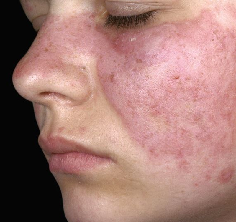 Bệnh lupus ban đỏ có nhổ răng được không? Dấu hiệu nhận biết là gì? 1