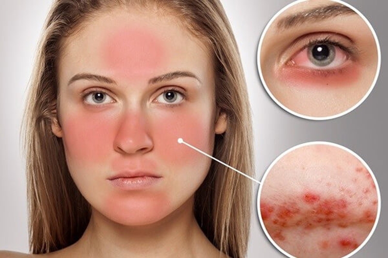 Bệnh lupus ban đỏ có nhổ răng được không? Dấu hiệu nhận biết là gì? 3