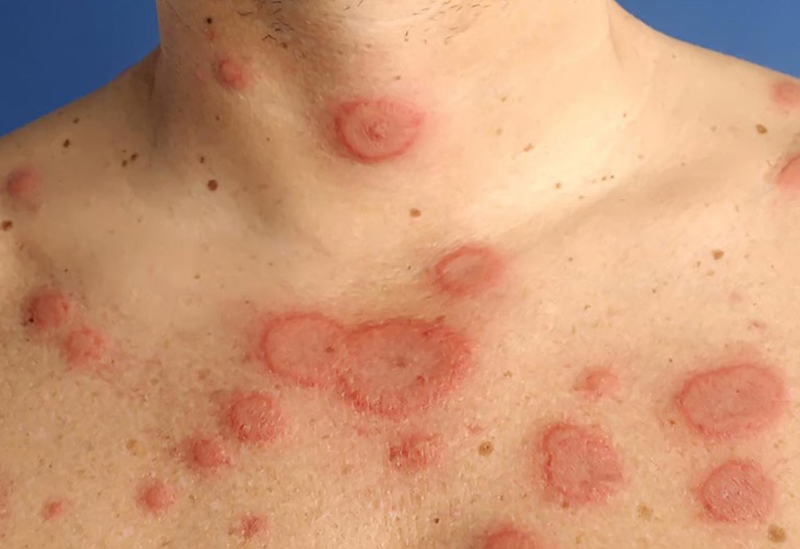 Chữa lupus ban đỏ bằng Đông y liệu có an toàn không? 1