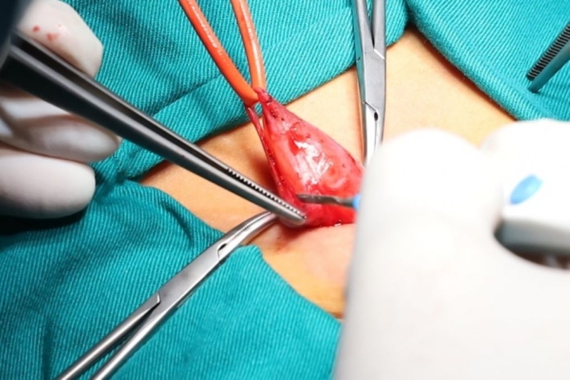 Bệnh lý còn ống phúc tinh mạc ở trẻ em 3