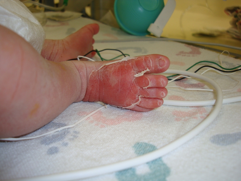 Bệnh ly thượng bì bẩm sinh có chữa được không 3