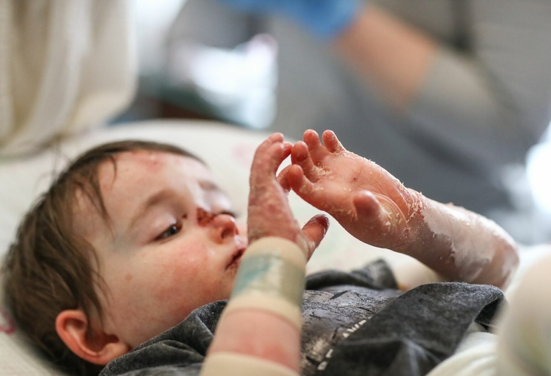 Bệnh ly thượng bì bẩm sinh có chữa được không 4