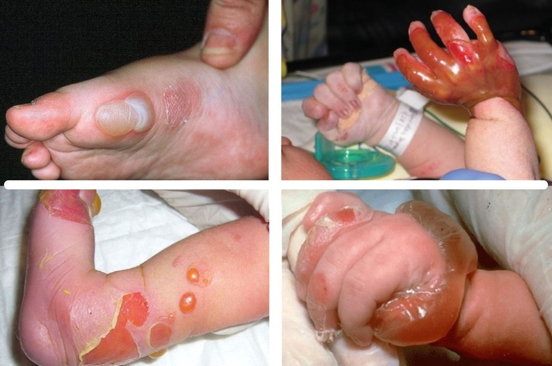 Bệnh ly thượng bì bẩm sinh có chữa được không 1