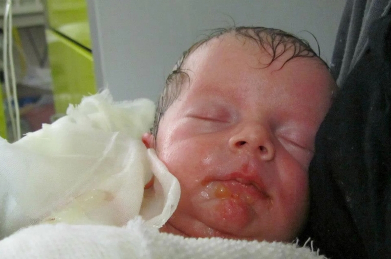 Bệnh ly thượng bì bẩm sinh có chữa được không 2