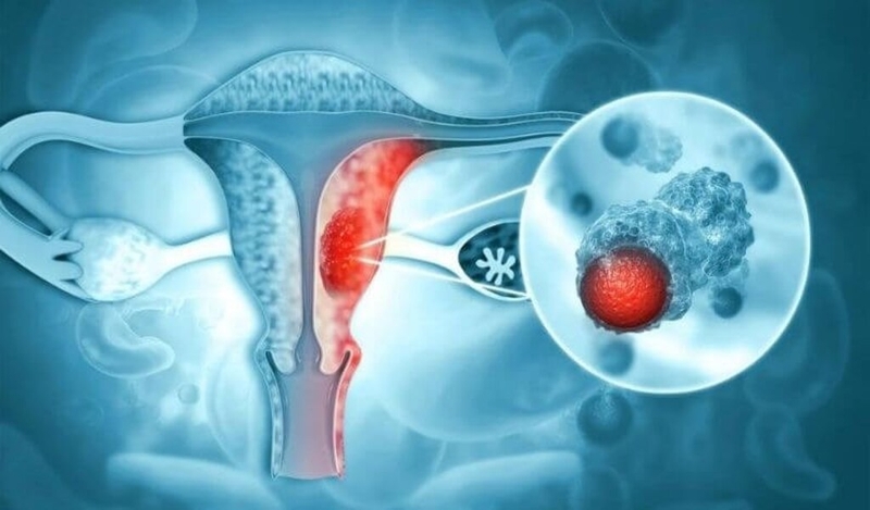 Bệnh lý tử cung là gì? Những điều cần biết trước khi mang thai 3