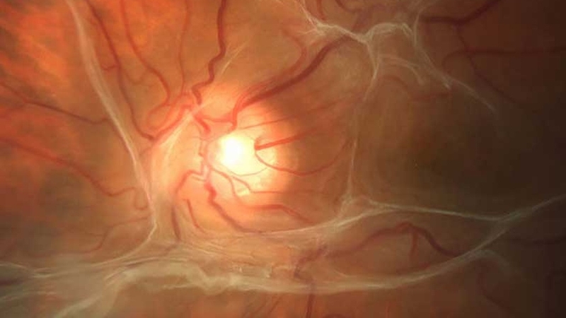 Bệnh màng tăng sinh trước võng mạc: Nguyên nhân, triệu chứng và cách điều trị 1