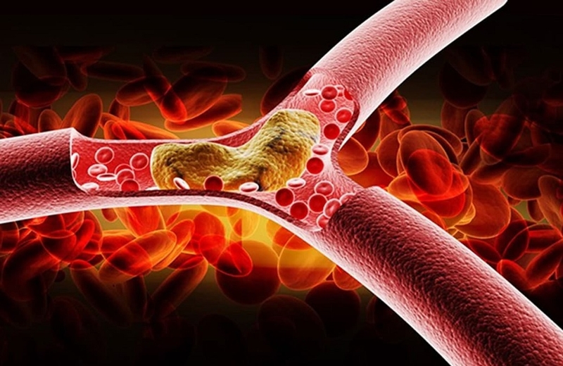 Bệnh máu nhiễm mỡ có nguy hiểm không? Cách phòng tránh bệnh thế nào? 2