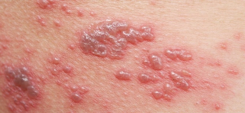 Bệnh mụn cóc sinh dục để lại hậu quả như thế nào 1