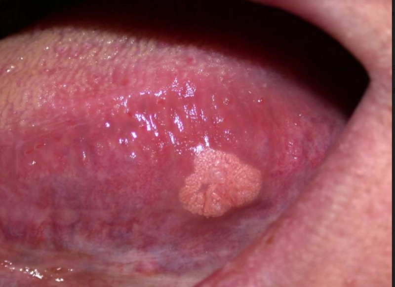 Bệnh mụn cóc sinh dục để lại hậu quả như thế nào 2