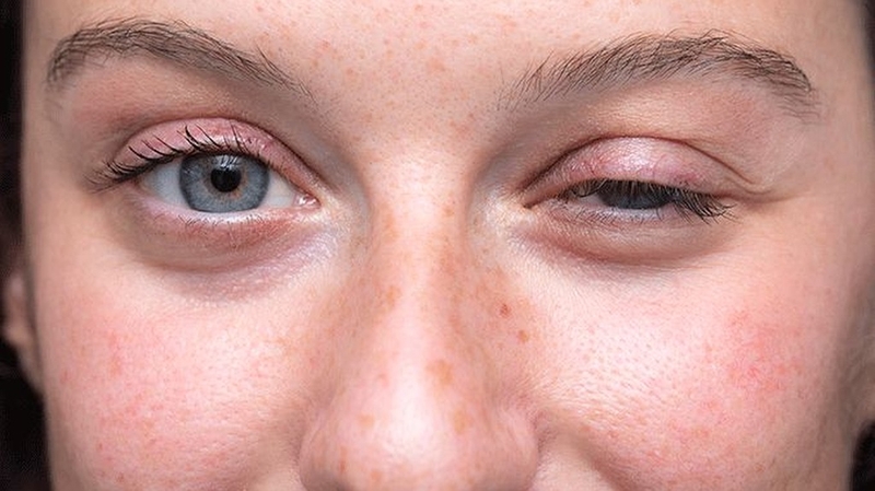 Bệnh myasthenia gravis là gì? Cơ chế hình thành bệnh nhược cơ 3