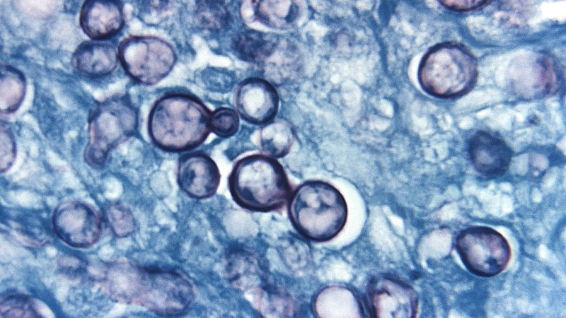 Bệnh nấm Histoplasmosis là bệnh gì? Triệu chứng và phương pháp điều trị