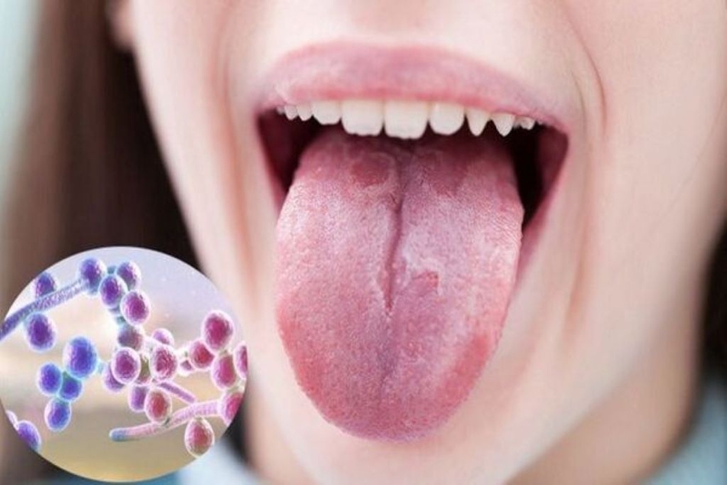 Bệnh nấm HIV: Nguyên nhân, triệu chứng và cách phòng ngừa hiệu quả 1