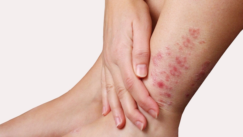 Bệnh nấm sâu và các loại nấm sâu thường gặp 1