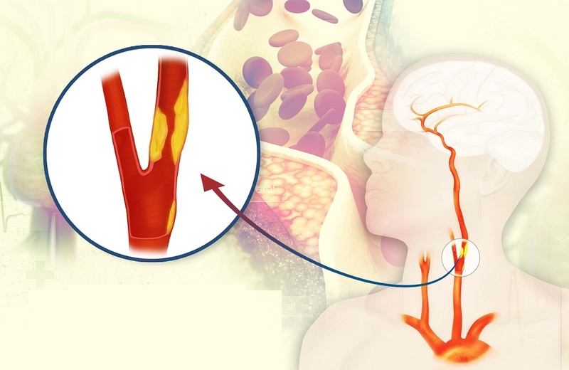 Bệnh nhân bị tai biến mạch máu não nặng có khả năng hồi phục không? 1