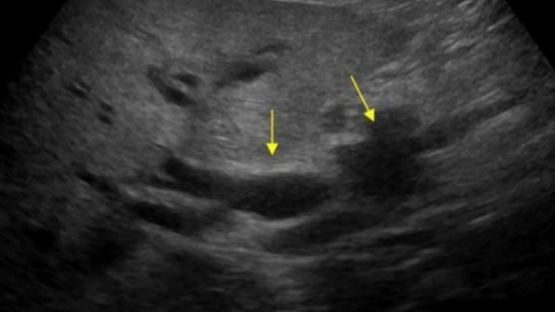 Bệnh nhân bị u bóng Vater sống được bao lâu? 1