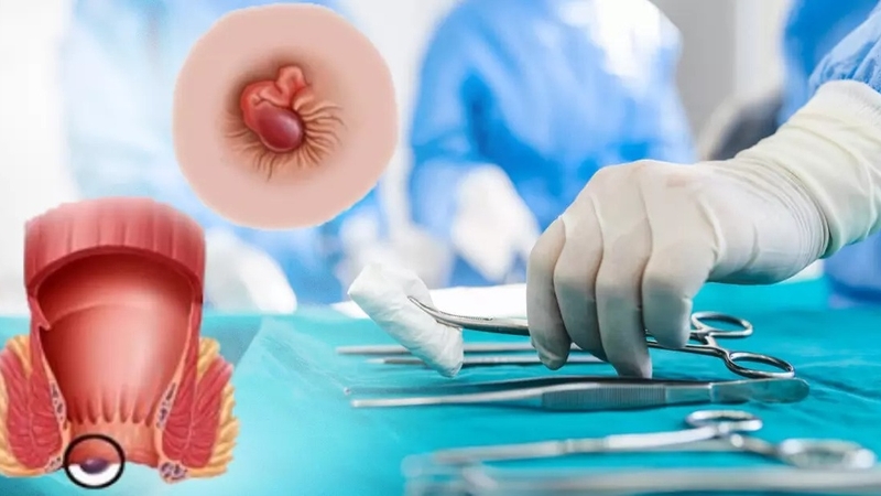 Bệnh nhân cắt trĩ bao lâu thì hết dịch? Chăm sóc sau mổ trĩ để nhanh hết dịch 1