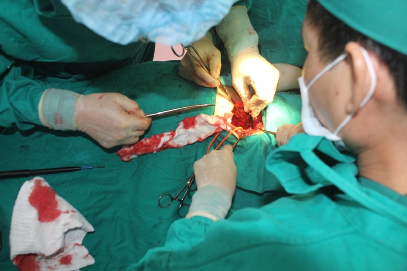 Bệnh nhân mắc sỏi thận có cần mổ không 1