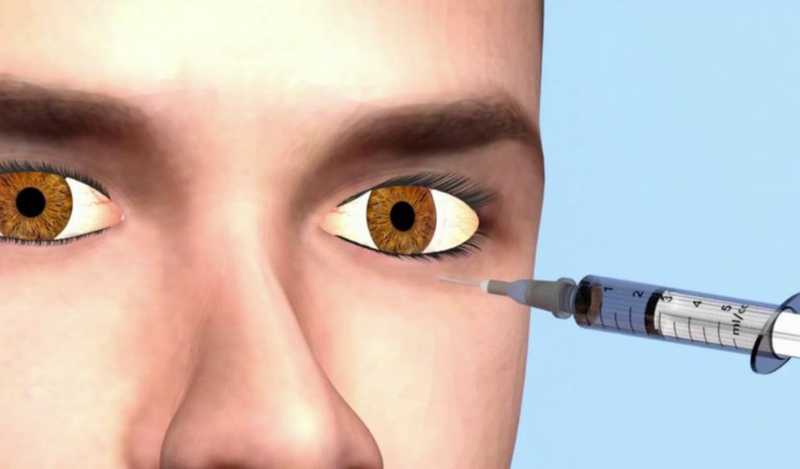 Mổ bong võng mạc là gì?