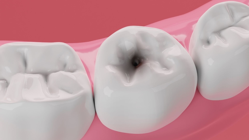 Bệnh nhân răng cửa bị sâu có trám được không? 1