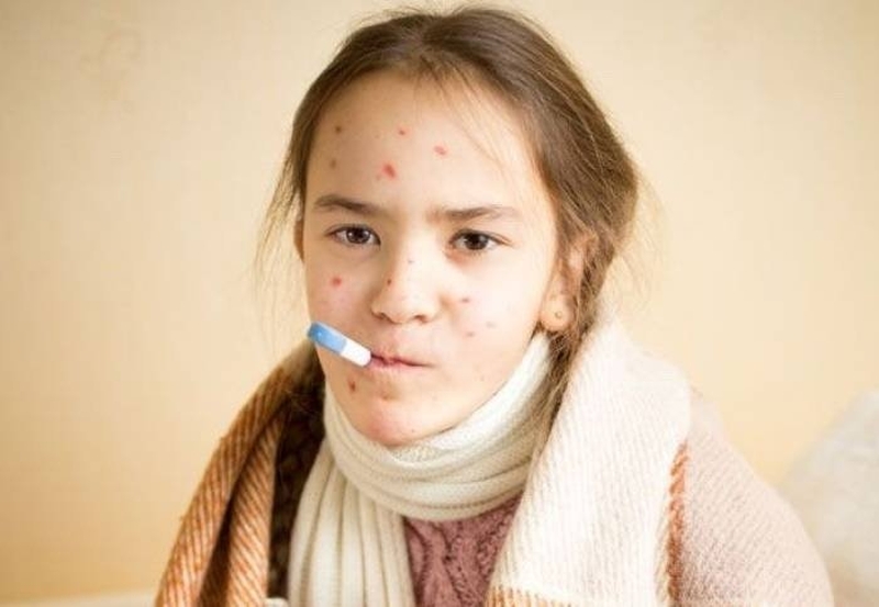 Bệnh nhân từng mắc thủy đậu có nguy cơ bị lại không 2