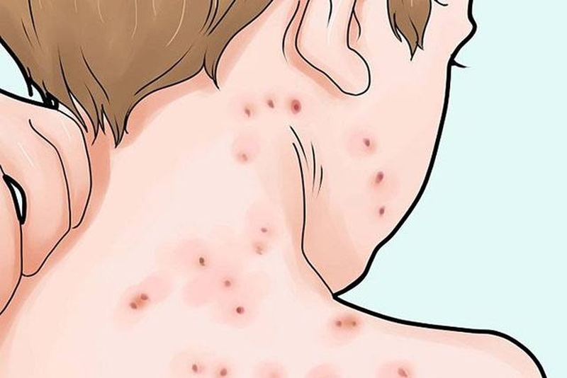 Bệnh nhân từng mắc thủy đậu có nguy cơ bị lại không 3