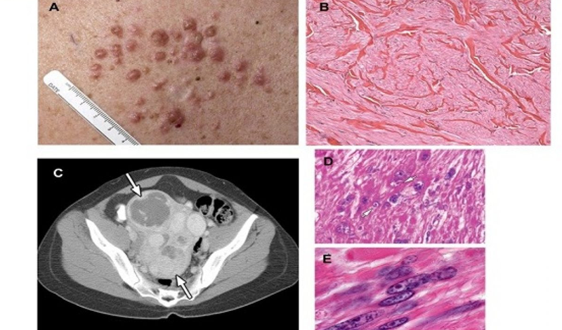 HLRCC có đột biến gen FH làm tăng nguy cơ ung thư