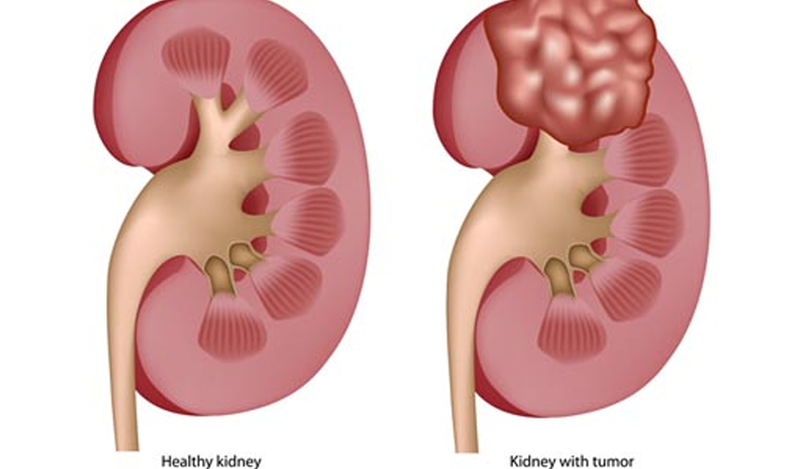 HLRCC làm tăng nguy cơ ung thư thận