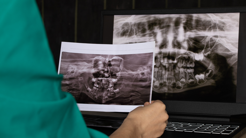 Bệnh Cancrum oris nguy hiểm như thế nào?3