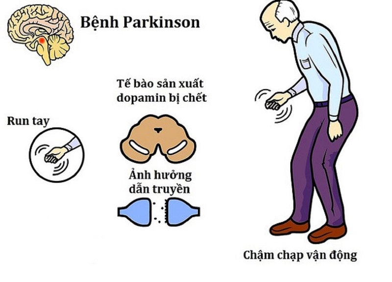 Giải đáp: Bệnh Parkinson có chữa được không? 1