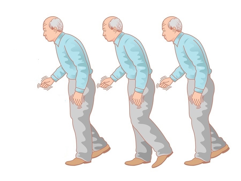 Bệnh Parkinson có mấy giai đoạn và dấu hiệu của từng giai đoạn 2