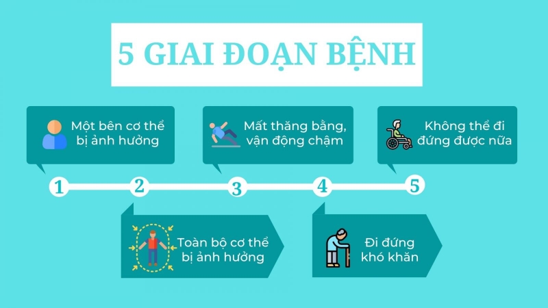 Bệnh Parkinson có mấy giai đoạn và dấu hiệu của từng giai đoạn 3