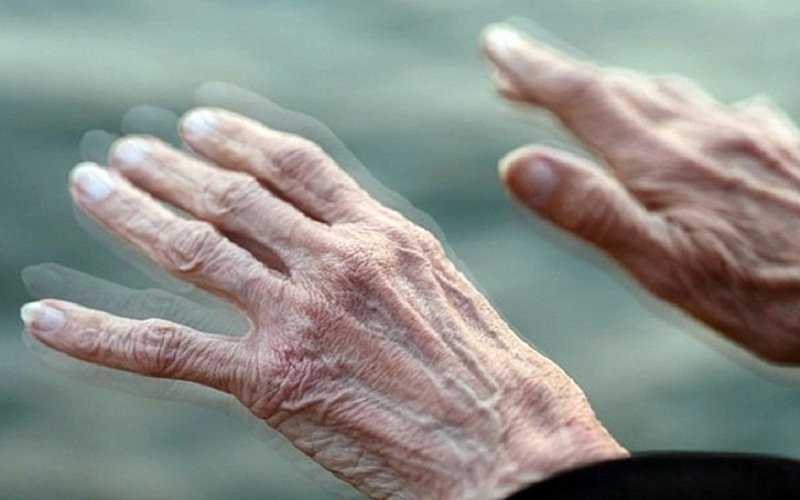 Bệnh Parkinson có mấy giai đoạn và dấu hiệu của từng giai đoạn 4