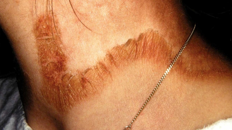 Bệnh Pellagra là bệnh gì? Một số điều cần biết về bệnh Pellagra 5