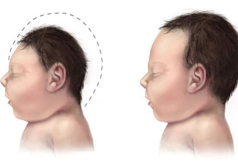 Bệnh pheninketo niệu: Cách phát hiện sớm và điều trị hiệu quả tránh hậu quả nghiêm trọng 1
