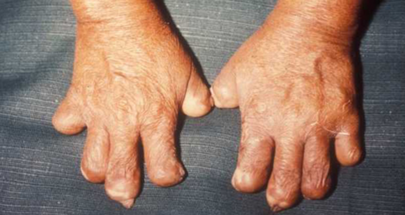 Bệnh phong cùi có lây không? Bệnh nguy hiểm như thế nào? 1