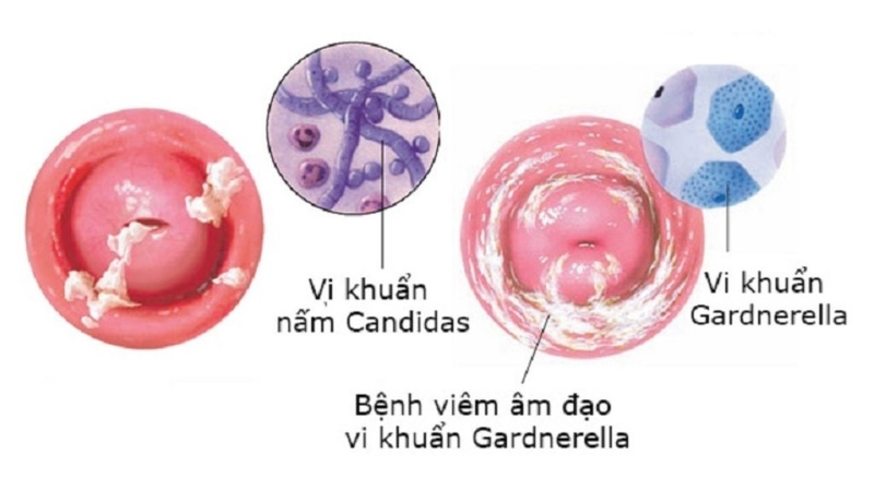 Bệnh phụ khoa: Nữ giới tuyệt đối không thể chủ quan  1