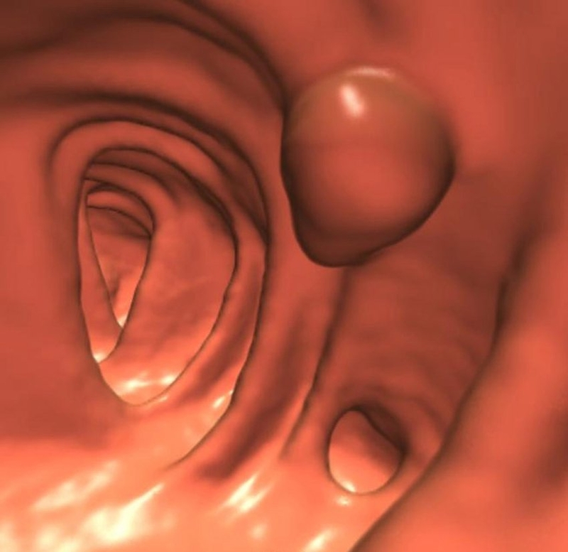 Bệnh polyp đại tràng là gì và biện pháp điều trị 1