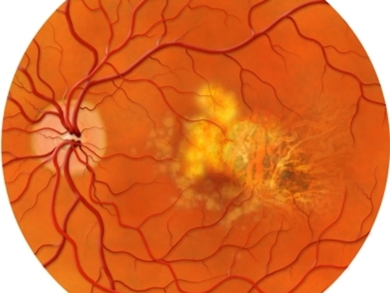 Bệnh quáng gà bẩm sinh có chữa được không? 1