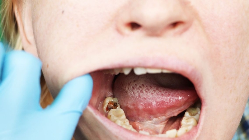 Bệnh răng miệng ở học sinh cần được phát hiện sớm và điều trị kịp thời