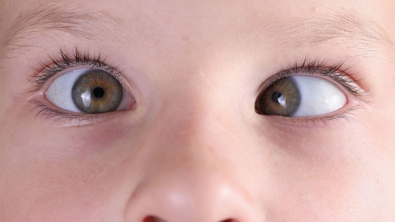 Bệnh rung giật nhãn cầu bẩm sinh là gì?2