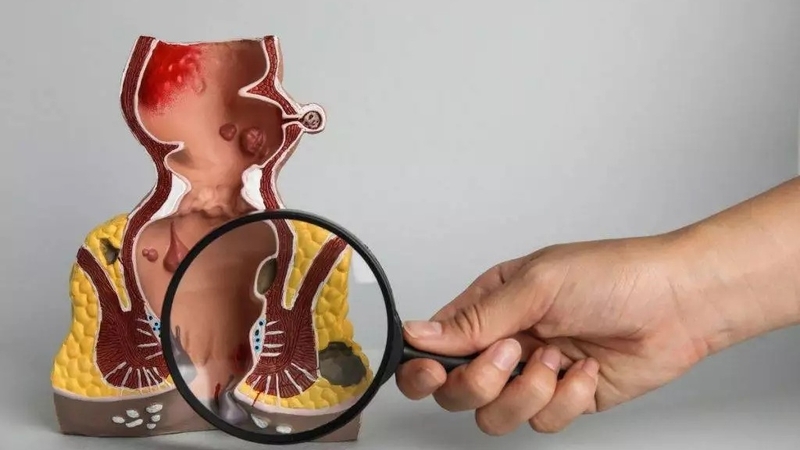 Bệnh sa trực tràng có nguy hiểm không? 3