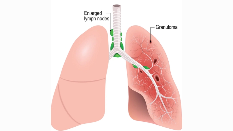 Bệnh Sacoit là bệnh gì? Những thông tin cần biết về bệnh Scoit 1