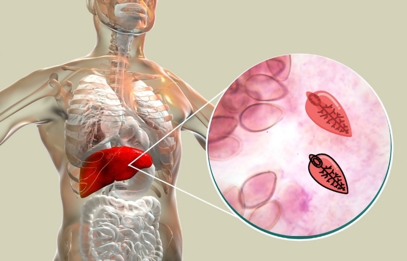 Sán lá gan ở người là một căn bệnh nguy hiểm có thể gây ra nhiều biến chứng ảnh hưởng nghiêm trọng
