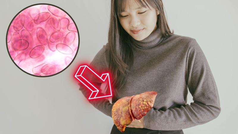 Bệnh sán lá gan ở người có nguy hiểm không?-2