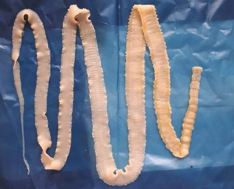 Bệnh sán thần kinh trung ương và những điều có thể bạn chưa biết